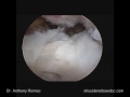 Arthroscopic Subscapularis Repair with Anthony A. Romeo, M.D., Part 4 Arthroscopic Subscapularis Repair with Anthony A. Romeo, M.D., Part 4