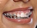 Remove Braces with Photoshop