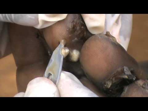 how to treat jigger infestation