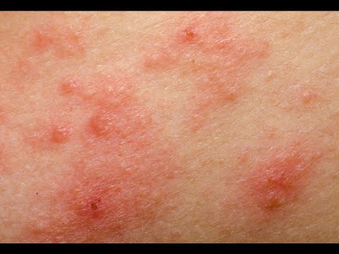 how to eliminate rosacea