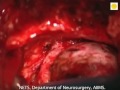 Neurosurgery video cavernous hemangioma of cavernous sinus