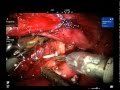 Robotic Retroperitoneal Lymph Nodes Removal Robotic Retroperitoneal Lymph Nodes Removal