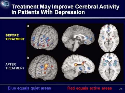 how to treat mdd