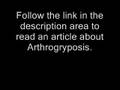 An Article About Arthrogryposis