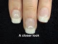 Bitten Nails Bitten Nails