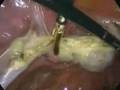 Oophrectomy