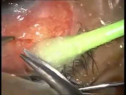 how to perform eye care on a patient