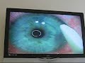 My Custom Intralase Surgery