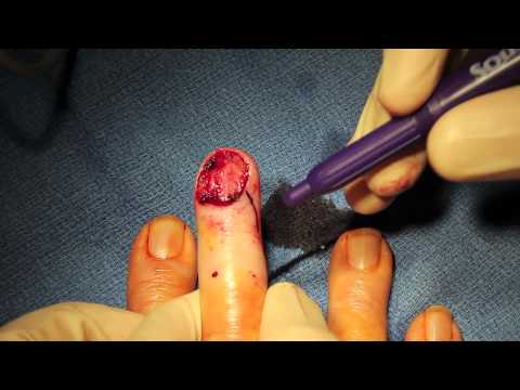 Amputation - This video demonstrates how to perform a completion amputation of a distal fingertip. Getting the amputation performed correctly at the time of initial prese...