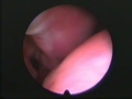 Perforación tabique nasal Perforación tabique nasal