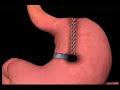 Vertical Banded Gastroplasty