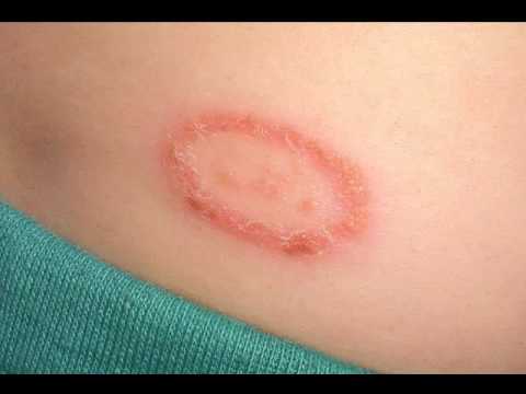 how to remove ringworm