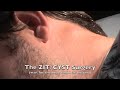Awesome Zit Cyst Surgery