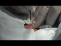 Awesome Zit Cyst Surgery
