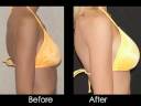 Short-Breast Augmentation.mp4 Short-Breast Augmentation.mp4