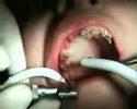 Flap Free Bone Graft III
