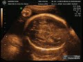 Joaquín con 28 semanas
