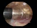 Subacromial Decompression with StableVac Fluid Management System Subacromial Decompression with StableVac Fluid Management System