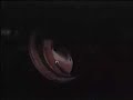 vitrectomy for macular pucker