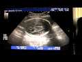 Micaiah's 29 Week Ultrasound