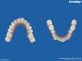 YouTube Video: This video details the movement created by Invisalign aligners YouTube Video: This video details the movement created by Invisalign aligners