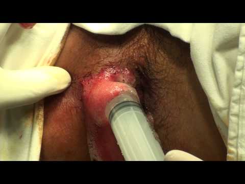PERIANAL ABSCESS - This video contains scenes of surgical operation. It may not be suitable to some people. Viewer discreation is advised.