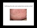 Click here to watch this video Get Rapid Relief From Skin Conditions Psoriasis Eczema