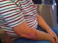 Scabby Snack (Man Eats Scab)