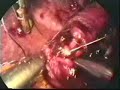 LAPARASCOPIC choledocojejunostomy-2 LAPARASCOPIC choledocojejunostomy-2