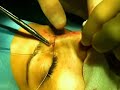 Click here to watch this video Lifting al naso - Rinoplastica non invasiva - Dr. De Fazio