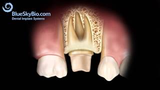 Crown Lengthening