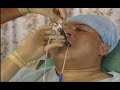 Awake iLMA� intubation