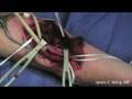 Excision Of Distal End Of Humerus Due To Giant Cell Tumor - 3/6