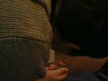 YouTube Video Removing Surgery Staples from Back Operation the Wrong Way