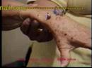 reumatoide artritis-01-
