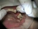Immediate Implant Loading #12