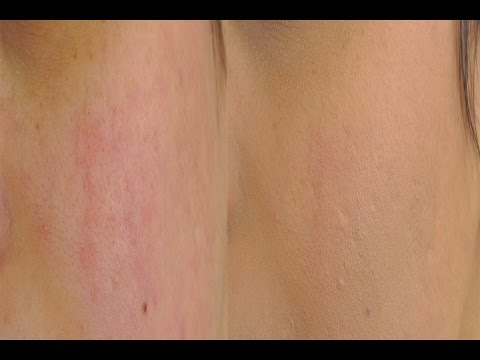 Eliminer acne et cicatrice rapidement - remove acne and scars