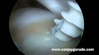Arthroscopic rotator cuff repair