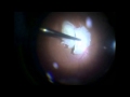 Click to View : Phacofragmentation for nucleus drop