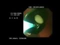 Endoskopik Mide Balonu Çıkartılması (Intragastric Balloon)