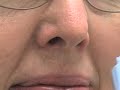 CO2 For Allergies