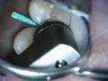Class II Can Opener prep with Er:YAG laser