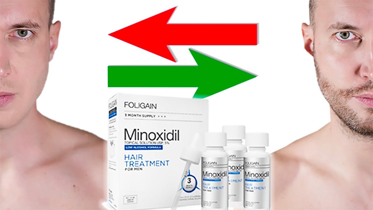 Dejarse crecer la barba con minoxidil (mi opinión)