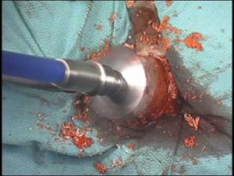 Resurfacing Hip Arthroplasty. Anterior Hip Replacement