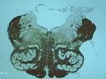 Medulla (Level of CN X and XII)