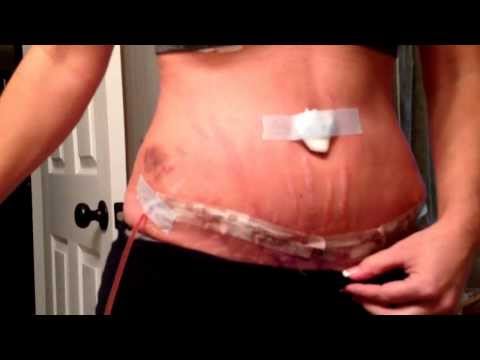 how to relieve swelling after breast augmentation