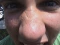 Chlorine and Alcohol Bomb Gone Wrong