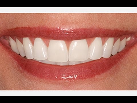 how to whiten teeth in pse 7