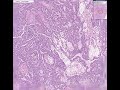Histopathology Testis--Endodermal sinus tumor (yolk sac tumo