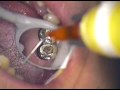 This procedure was performed as an economical treatment alternative to remaking a four tooth bridge. The bridge will be monitored over time for any changes in marginal integrity. Feel free to contact me for information on microscope use and the techniques expressed in this video at mailbox@gcuomodds.com or call 561-391-6290